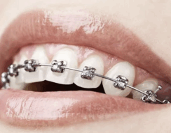 A confident smile starts with the right alignment – braces in action!